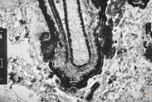 M,66y. | follicular cyst with hyaline Rushton bodies M,66y. | follicular cyst with hyaline Rushton bodies